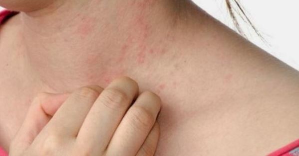 If you get a lot of skin rashes all of a sudden when you didn't before, this can also be a sign of HIV. 
