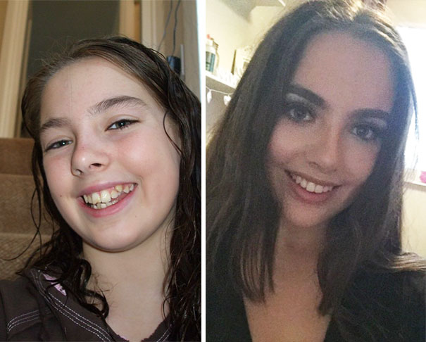 14. 4 Years Difference Amen For Braces