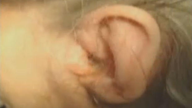 57 Maggots in a woman's ear